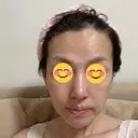 鼻尖形成（切開） / 鼻中隔延長（切開） / 小鼻縮小（切開） / 鼻尖縮小 グローバルビューティークリニック 東京院 DAY 21 サムネイル用