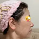 鼻尖形成（切開） / 鼻中隔延長（切開） / 小鼻縮小（切開） / 鼻尖縮小 グローバルビューティークリニック 東京院 DAY 21 サムネイル用