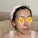 鼻尖形成（切開） / 鼻中隔延長（切開） / 小鼻縮小（切開） / 鼻尖縮小 グローバルビューティークリニック 東京院 DAY 21 サムネイル用