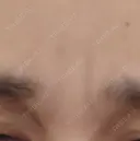 ボトックス（眉間） TCB東京中央美容外科 新横浜院 DAY 33 サムネイル用