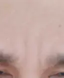 ボトックス（眉間） TCB東京中央美容外科 新横浜院 DAY 34 サムネイル用