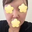 隆鼻術 / 鼻尖形成（切開） / 軟骨移植 エースクリニック 名古屋院 DAY 31 サムネイル用