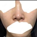 鼻尖形成（切開） / 軟骨移植 / 鼻尖縮小 ASTRA BEAUTY CLINIC DAY 17 サムネイル用