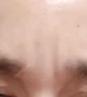 ボトックス（眉間） TCB東京中央美容外科 新横浜院 DAY 34 サムネイル用