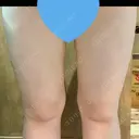 脂肪冷却（太もも） Anterior 大阪梅田院 DAY 7 サムネイル用