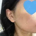 光治療（フォトフェイシャルなど） メディアージュクリニック 名古屋院 DAY 5 サムネイル用