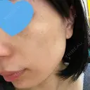 光治療（フォトフェイシャルなど） メディアージュクリニック 名古屋院 DAY 5 サムネイル用