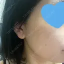 光治療（フォトフェイシャルなど） メディアージュクリニック 名古屋院 DAY 6 サムネイル用