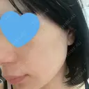 光治療（フォトフェイシャルなど） メディアージュクリニック 名古屋院 DAY 6 サムネイル用