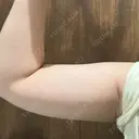 脂肪冷却（二の腕） Anterior 大阪梅田院 DAY 52 サムネイル用