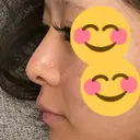 目頭切開 / その他（鼻） / ヒアルロン酸注入（鼻） BIANCA銀座 DAY 241 サムネイル用