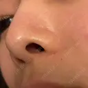 目頭切開 / その他（鼻） / ヒアルロン酸注入（鼻） BIANCA銀座 DAY 241 サムネイル用