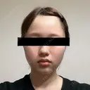 糸リフト / バッカルファット除去 SEA CLINIC（シークリニック） DAY 18 サムネイル用