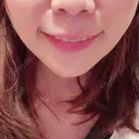 ヒアルロン酸注入（あご） TCB東京中央美容外科 世田谷院 DAY 3 サムネイル用