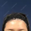 脂肪注入（額） S.T styleクリニック DAY 43 サムネイル用