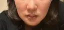 ニードルRF（ポテンツァなど） ゆう美容クリニック DAY 3 サムネイル用