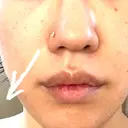 その他（目元） / ボトックス（口角） / ボトックス（人中） ルラ美容クリニック 渋谷本院 AFTER サムネイル用