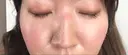 美肌レーザー / シミ取りレーザー / ルビーレーザー 銀座お肌の診療所 AFTER サムネイル用