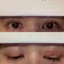 二重埋没 / 糸リフト / 下まぶたの脂肪取り / 目元修正 / 肌ヒアルロン酸注入（たるみ・シワ改善） ネビュラクリニック 広島院 DAY 2 サムネイル用