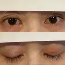 二重埋没 / 糸リフト / 下まぶたの脂肪取り / 目元修正 / 肌ヒアルロン酸注入（たるみ・シワ改善） ネビュラクリニック 広島院 DAY 5 サムネイル用