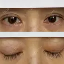 二重埋没 / 糸リフト / 下まぶたの脂肪取り / 目元修正 / 肌ヒアルロン酸注入（たるみ・シワ改善） ネビュラクリニック 広島院 DAY 7 サムネイル用