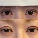 二重埋没 / 糸リフト / 下まぶたの脂肪取り / 目元修正 / 肌ヒアルロン酸注入（たるみ・シワ改善） ネビュラクリニック 広島院 DAY 0 サムネイル用