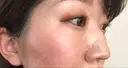 美肌レーザー / シミ取りレーザー / ルビーレーザー 銀座お肌の診療所 DAY 32 サムネイル用