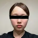 糸リフト / バッカルファット除去 SEA CLINIC（シークリニック） DAY 24 サムネイル用