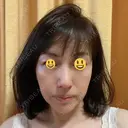 鼻尖形成（切開） / 鼻中隔延長（切開） / 小鼻縮小（切開） / 鼻尖縮小 グローバルビューティークリニック 東京院 AFTER サムネイル用
