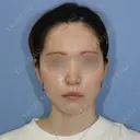 糸リフト / 脂肪吸引（顔） 加藤クリニック 麻布東京院 AFTER サムネイル用