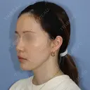 糸リフト / 脂肪吸引（顔） 加藤クリニック 麻布東京院 DAY 117 サムネイル用