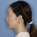 糸リフト / 脂肪吸引（顔） 加藤クリニック 麻布東京院 DAY 117 サムネイル用