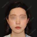 糸リフト / 脂肪吸引（顔） 加藤クリニック 麻布東京院 DAY 30 サムネイル用