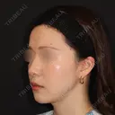 糸リフト / 脂肪吸引（顔） 加藤クリニック 麻布東京院 DAY 30 サムネイル用