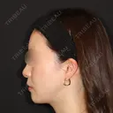 糸リフト / 脂肪吸引（顔） 加藤クリニック 麻布東京院 DAY 30 サムネイル用