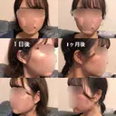 ボトックス（エラ・小顔） 湘南美容クリニック 大宮院 AFTER サムネイル用