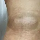 脂肪冷却（お腹） / 脂肪冷却（太もも） / 脂肪冷却（お尻） / 脂肪冷却（背中・ブラファット） 共立美容外科 仙台院 DAY 16 サムネイル用