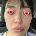 光治療（フォトフェイシャルなど） APOLLO BEAUTY CLINIC DAY 3 サムネイル用