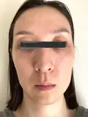 クマ治療 X CLINIC 銀座院 AFTER サムネイル用