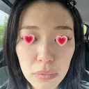 光治療（フォトフェイシャルなど） APOLLO BEAUTY CLINIC DAY 6 サムネイル用