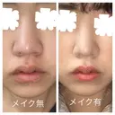 鼻尖形成（切開） / 小鼻縮小（切開） / その他（鼻） / 軟骨移植 JUN CLINIC DAY 42 サムネイル用