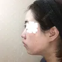鼻尖形成（切開） / 小鼻縮小（切開） / その他（鼻） / 軟骨移植 JUN CLINIC DAY 42 サムネイル用