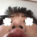 鼻尖形成（切開） / 小鼻縮小（切開） / その他（鼻） / 軟骨移植 JUN CLINIC DAY 42 サムネイル用