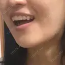 ボトックス（あご） Original Beauty Clinic GINZA DAY 28 サムネイル用