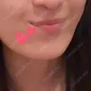 ボトックス（あご） Original Beauty Clinic GINZA DAY 27 サムネイル用