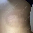 脂肪冷却（お腹） / 脂肪冷却（太もも） / 脂肪冷却（お尻） / 脂肪冷却（背中・ブラファット） 共立美容外科 仙台院 DAY 22 サムネイル用