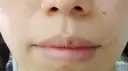 ボトックス（口角） YBC横浜美容外科 大宮院 DAY 36 サムネイル用