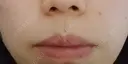 ボトックス（口角） YBC横浜美容外科 大宮院 DAY 37 サムネイル用