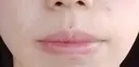 ボトックス（口角） YBC横浜美容外科 大宮院 DAY 39 サムネイル用