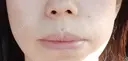 ボトックス（口角） YBC横浜美容外科 大宮院 DAY 41 サムネイル用